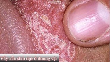 vảy nến ở dương vật