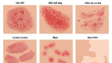 Bệnh da liễu thường gặp