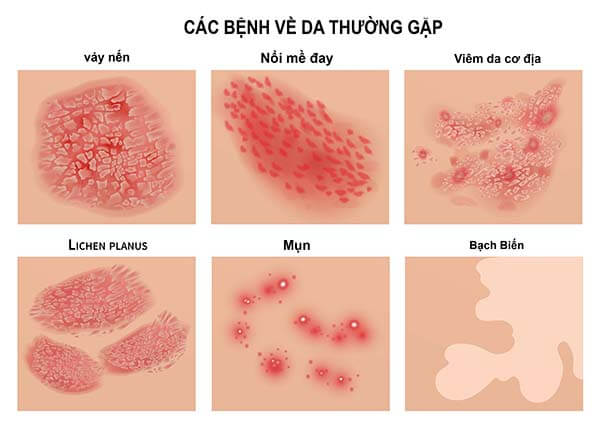 10+ bệnh da liễu thường gặp ở người lớn – cách điều trị hiệu quả