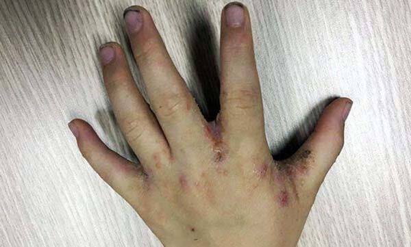 hình ảnh bệnh ghẻ ở kẽ tay