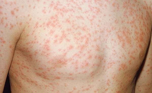 dan nnooiar mản đỏ ngứa như muỗi đốt