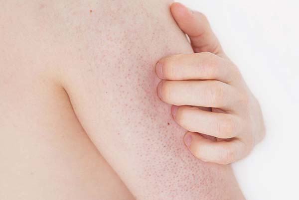 da nổi hột trăng do bệnh ghẻ