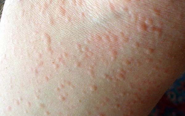 da nổi hột trắng do mè đay mẩn ngứa