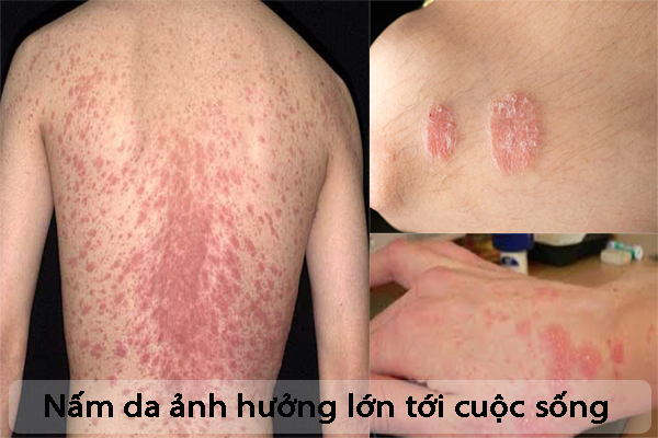 Bệnh nấm da: Nguyên nhân, triệu chứng và cách điều trị