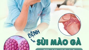 chữa sùi mào gà dứt điểm