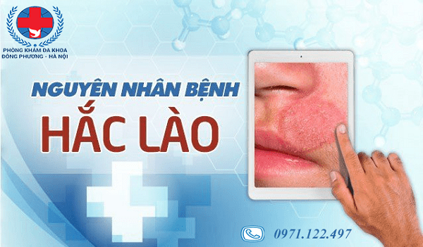 chữa bệnh hắc lào tại Nông Trang, Việt Trì