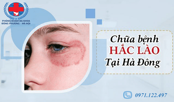 Chữa Hắc Lào Tại Hà Đông Dứt Điểm