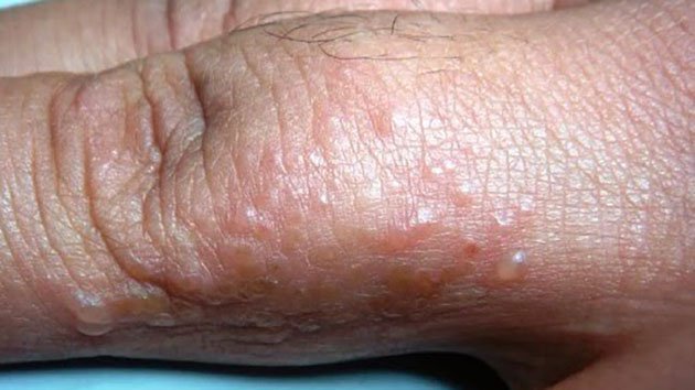 bệnh ghẻ nước có tự khỏi không