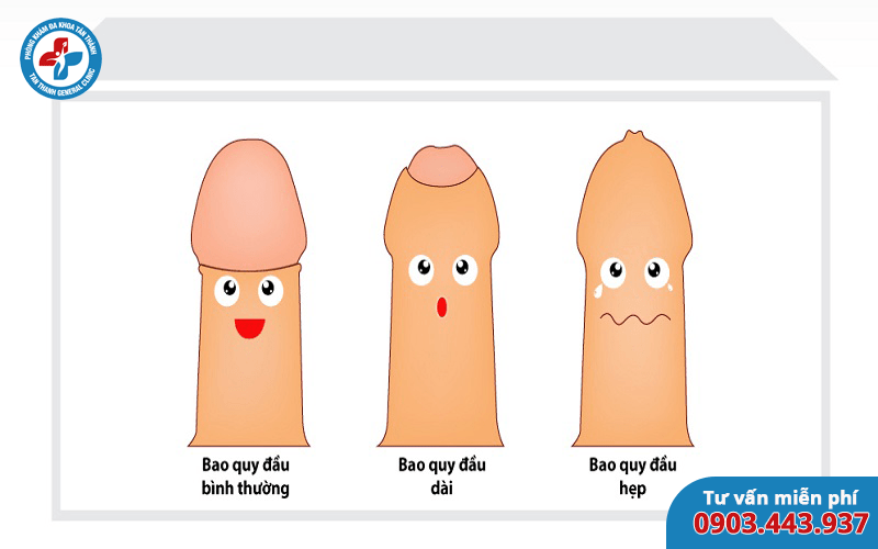 Dài bao quy đầu có nguy hiểm không?