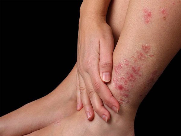 bệnh ghẻ nước có lây không