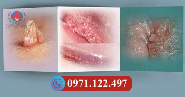 sùi mào gà có tự khỏi không