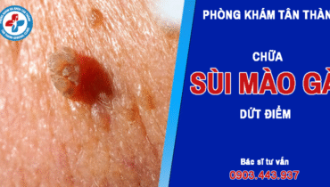 Chữa sùi mào gà dứt điểm
