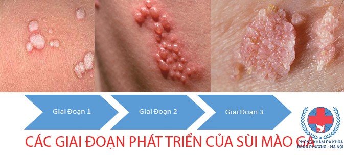sùi mào gà có tự khỏi không