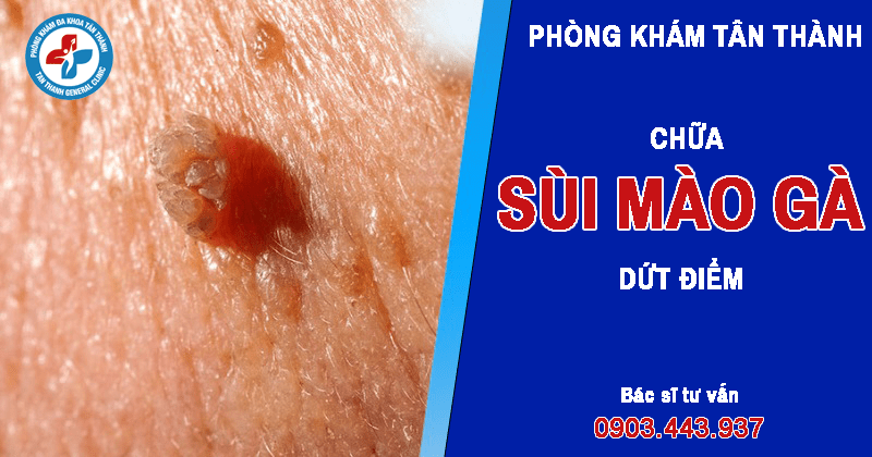 Chữa sùi mào gà ở Việt Trì, Phú Thọ dứt điểm