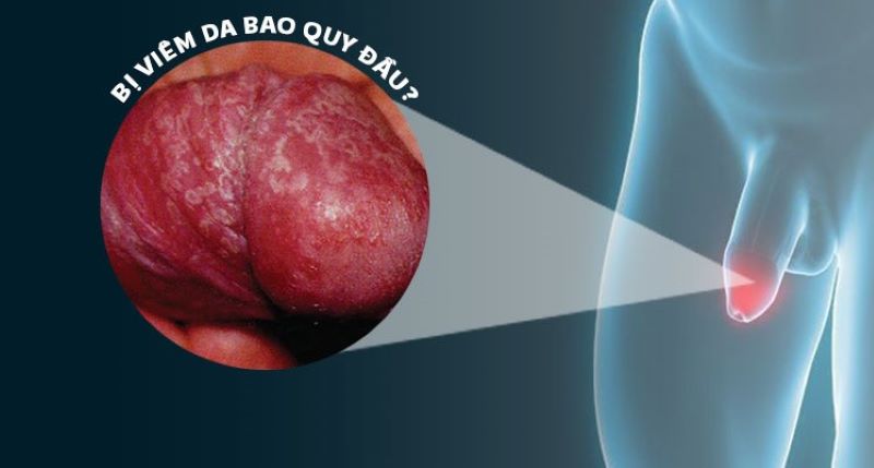 dài bao quy đầu có nên cắt không?