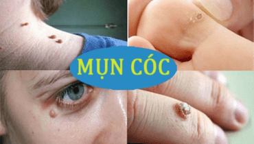 chữa mụn cóc ở tay tận gốc