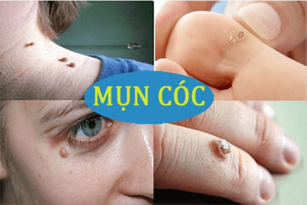 chữa mụn cóc ở tay tận gốc