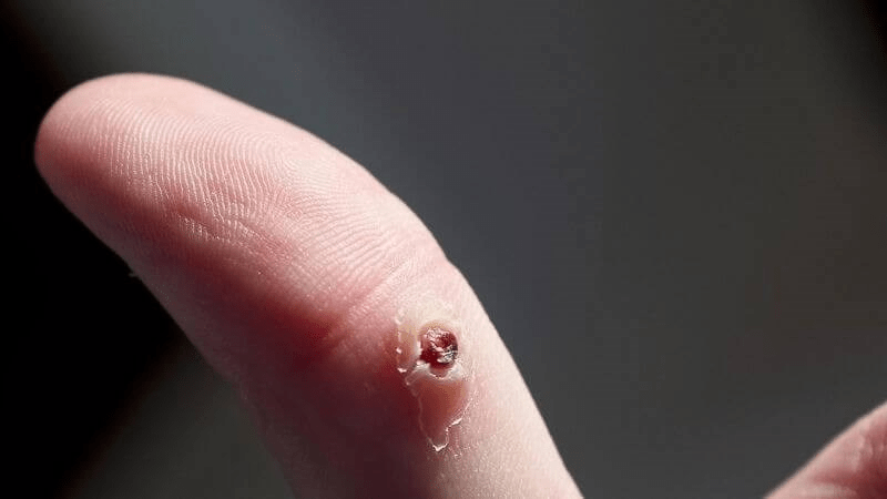 Nguyên nhân dẫn đến mụn cóc