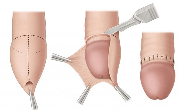 Cắt bao quy đầu